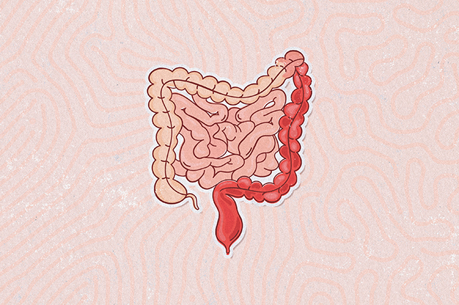 Ulcerative colitis is shown on a human intestinal system in red.