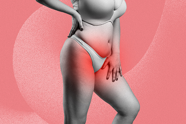 The lower half of a woman posed in underwear has redness around her pelvic region.