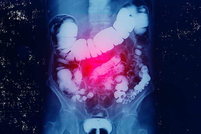 An x-ray of a human abdomen is glowing red around the intestinal system.