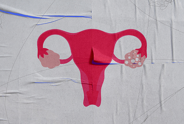 A pink female reproductive system is on a white textured paper with cysts in one ovary.