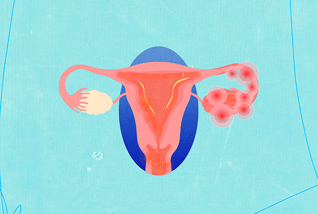 An orange female reproductive shows pelvic inflammatory disease on the left ovary.