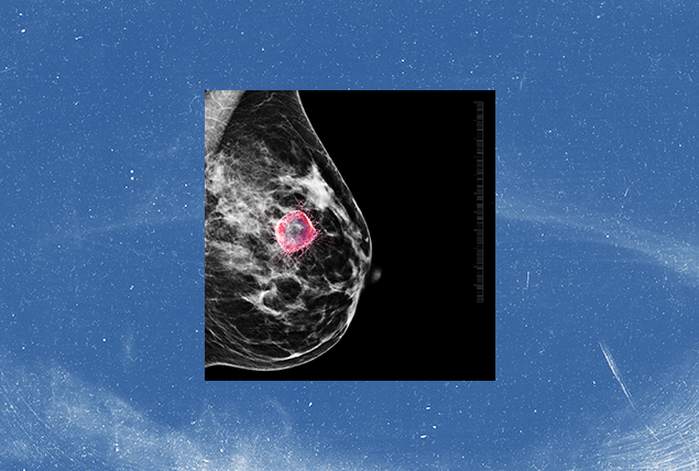 side x-ray of breast with red cancer cell getting bigger and smaller on blue background