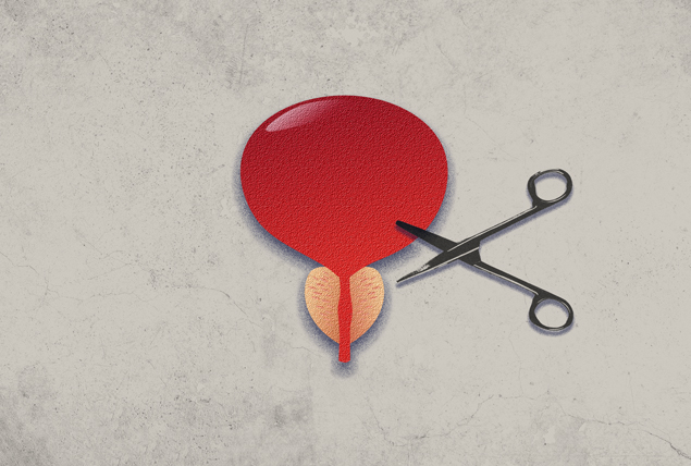 A pair of medical scissors cut into a red prostate.