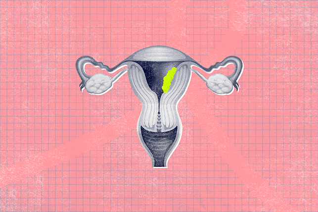 uterus with a lime green mass inside on a light pink background