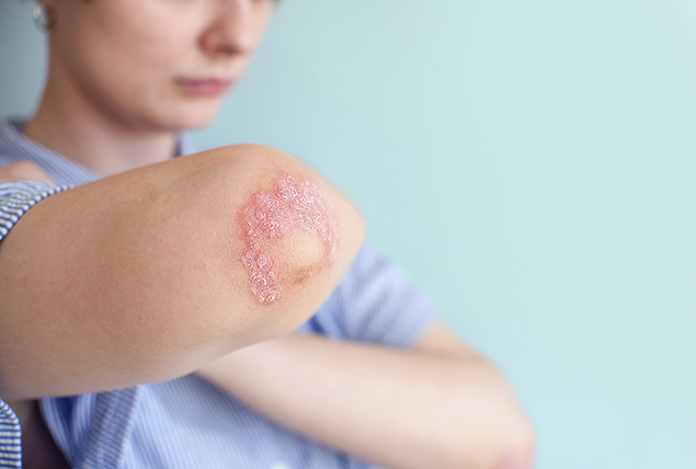 A woman shows her arm having psoriasis near the elbow.