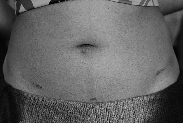 grayscale photo of woman's abdomen with laparoscopic procedure scars  