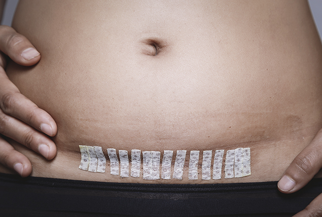 woman's bare stomach area with horizontal scar with medical tape