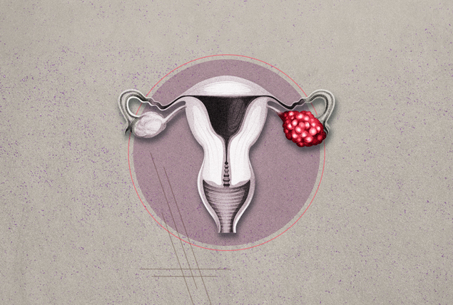 A diagram of the female reproductive system has a red inflamed ovary.