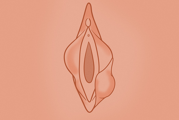 A peach illustration of a vagina shows a Bartholin cyst.