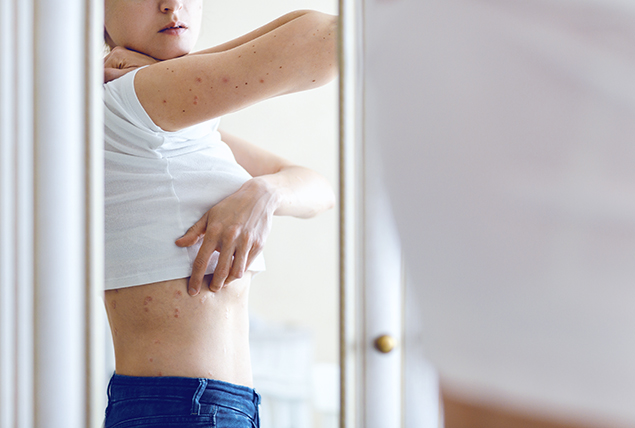 A woman lifts her white shirt to see the red rash spots on the side of her body.