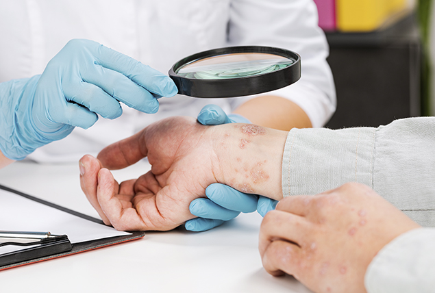 A doctor holds the arm of a patient with eczema and looks at the rash with a magnifying glass.