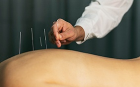 A-woman-lays-down-receiving-acupuncture