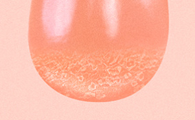 Scrotal cellulitis on the bottom of a testicle. 