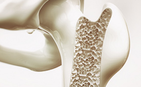 A cross section of the hip bone shows its density loss. 