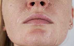 A pregnant woman is showing how the skin on her face is peeling.