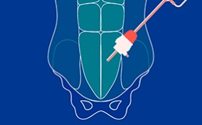 An outline of a male body from shoulders to pelvis has a robotic arm reaching towards the testicle area.