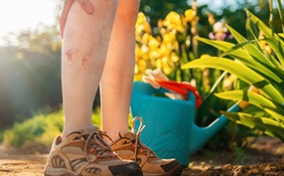 A woman standing in their garden is holding their knee and their calf in pain from deep vein thrombosis.