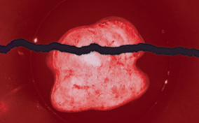 An x-ray of an ovarian cyst is ripped into two pieces against a purple background.
