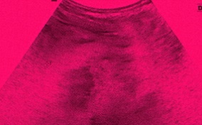 A sonogram from an ultrasound shows the uterus without a fetus.