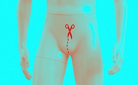 A male Barbie doll has a red incision line and scissors on the groin area against a bright teal background.