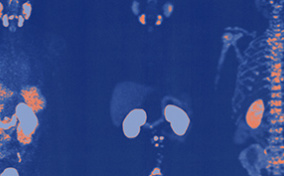 A blue x-ray from a PSMA PET scan is shown detecting prostate cancer in orange.