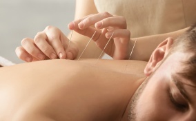 Acupuncture is performed on the back of a man.