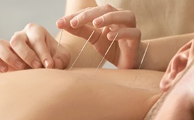 Acupuncture is performed on the back of a man.