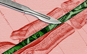 A diagrammed cross section of a penis has green money in place of the vas deferens and a scalpel lying across the image..