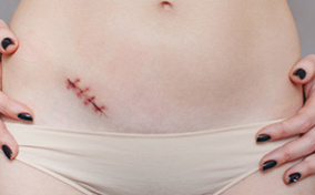 A person in underwear has their hands on their hips and a diagonal stitched up scar under their belly button.