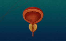 An orange prostate turns grey on top of a blue and green gradient background.