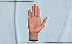 An open palm faces forward and has multiple red dots covering the surface.