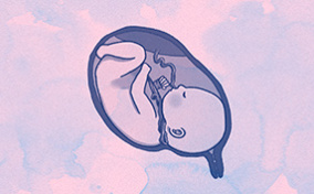 On a pink and blue cloudy background an upside down baby is curled in a uterus with the umbilical chord wrapped around its neck.