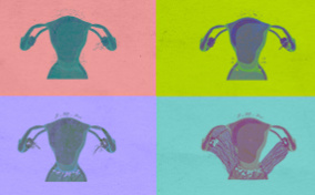 A 4x4 multicolor grid shows the four stages of endometriosis.