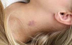 A blonde woman lays down with a hickey on her neck.