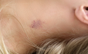 A blonde woman lays down with a hickey on her neck.