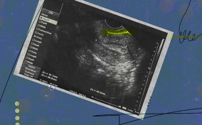 An endometrial stripe is highlighted in yellow on an ultrasound photograph.