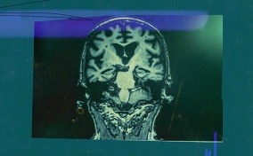 A green-tinted brain scan shows dark and light areas of the organ.