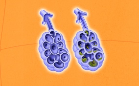 Two purple lungs are side-by-side against an orange background and one has green mucus in the alveoli.