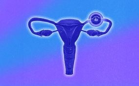 A purple female reproductive system has a bulging fallopian tube where an egg is implanted.