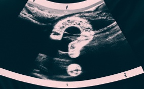 An ultrasound of a pregnancy has a large question mark over it.