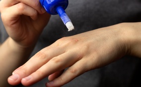 A hand holds ointment in their hand as they are able to apply it to a wart on the other hand.