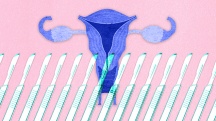 A row of scalpels is layered over a purple image of a reproductive system and a pink background.